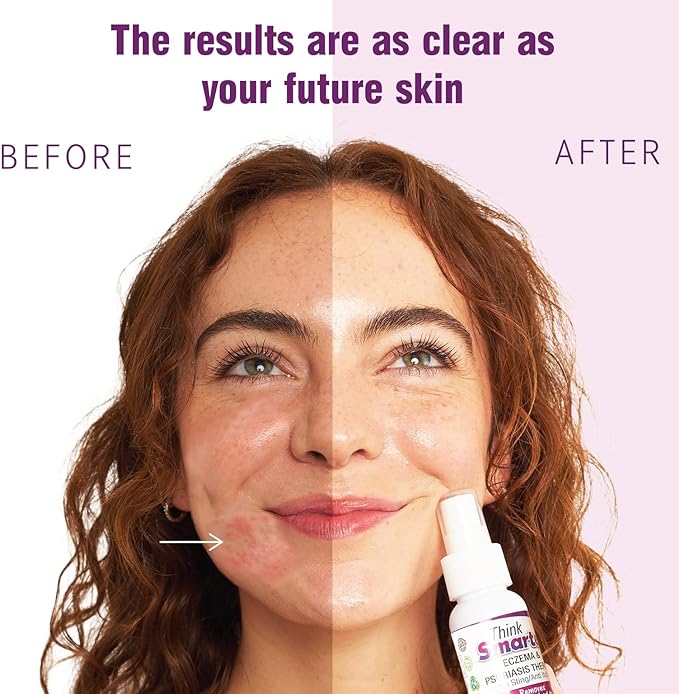 Think Smarter Products Eczema & Psoriasis Therapy with Hypochlorous Acid - Image 3